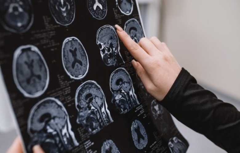 التغيرات الدماغية في مرض ألزهايمر تختلف حسب الجنس