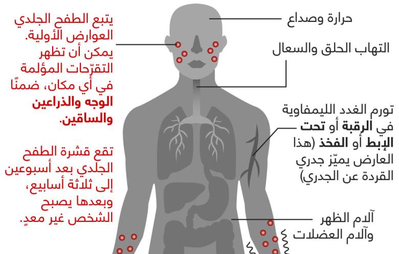 هل يمكن أن ينتقل جدري القرود عبر الملابس؟